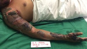 В Бразилии разработан революционный метод для лечения тяжелых ожогов с помощью кожи тилапии